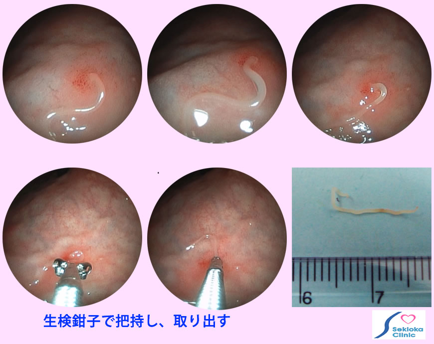 胃アニサキス　内視鏡画像