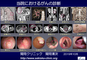 がんの診断