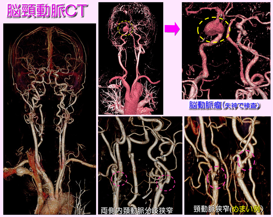 脳脳頸動脈CT検査