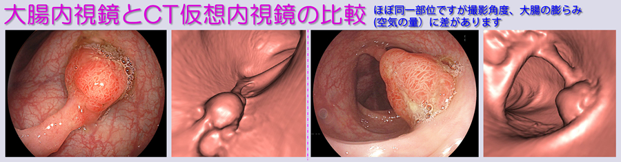 大腸内視鏡、大腸CT画像比較
