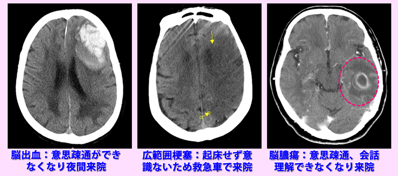 意識障害CT検査