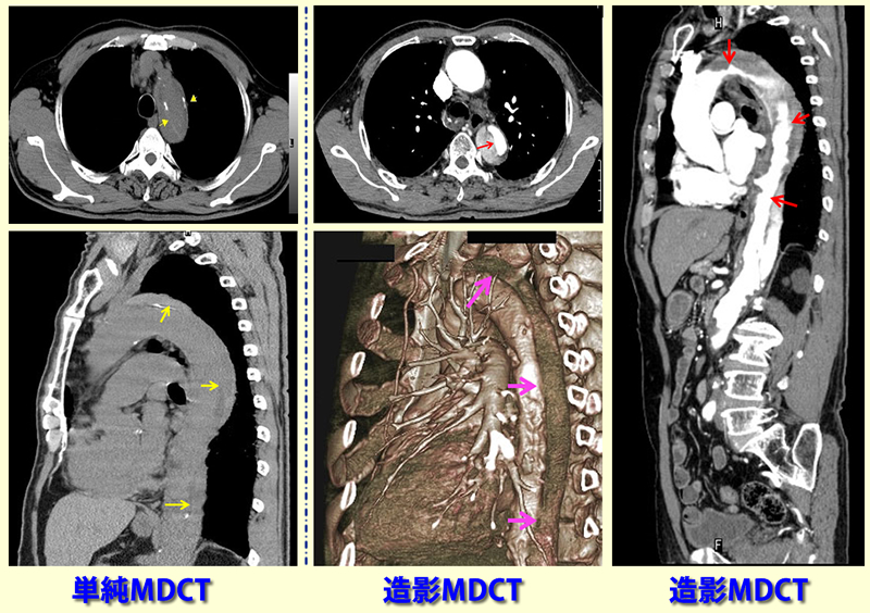 急性解離性大動脈瘤