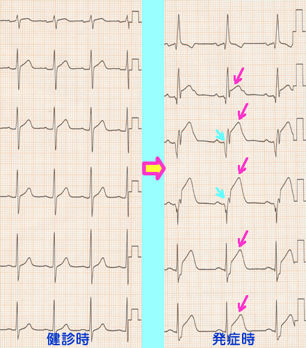 心筋梗塞時の心電図