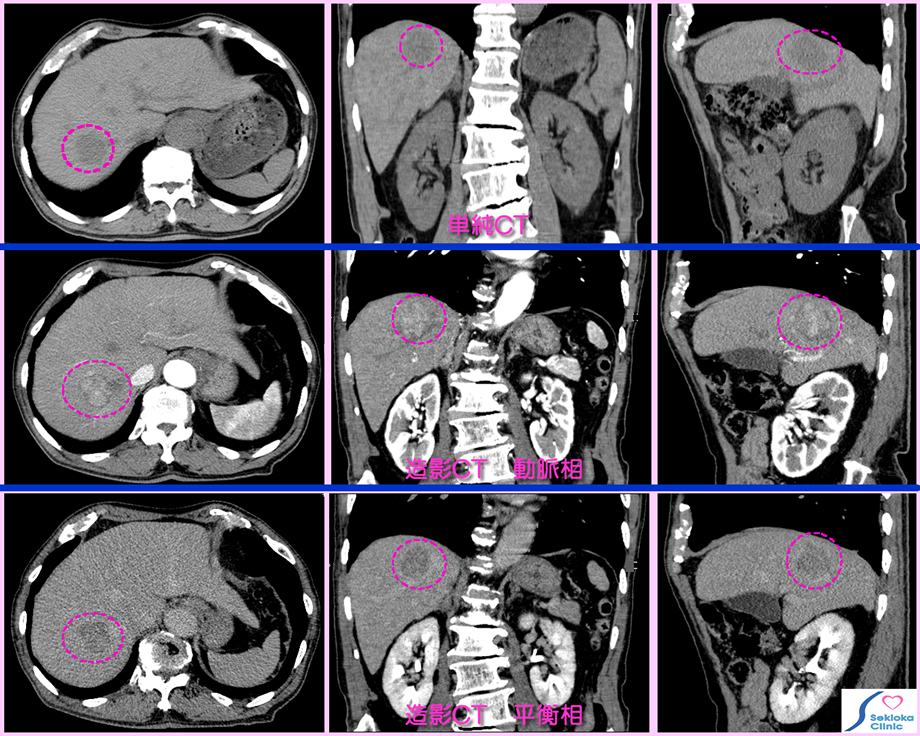 肝ガンのMDCT造影診断