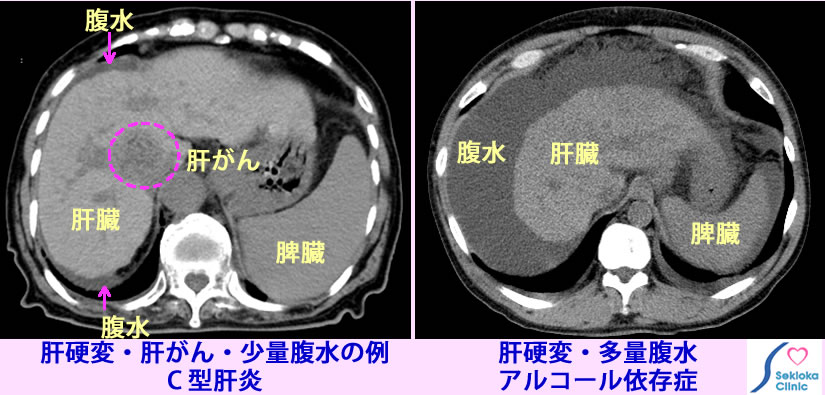 肝硬変　肝がん　CT