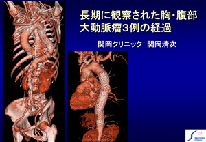 志摩臨床研究会　動脈瘤の診断と治療スライド