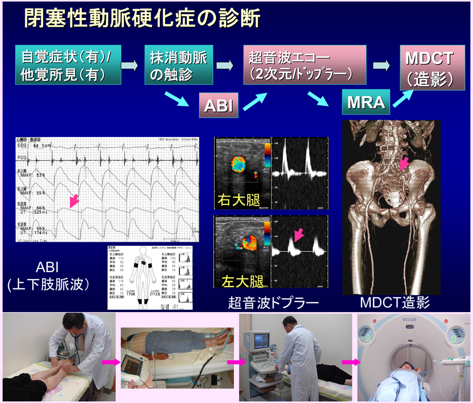 閉塞性動脈硬化症の診断