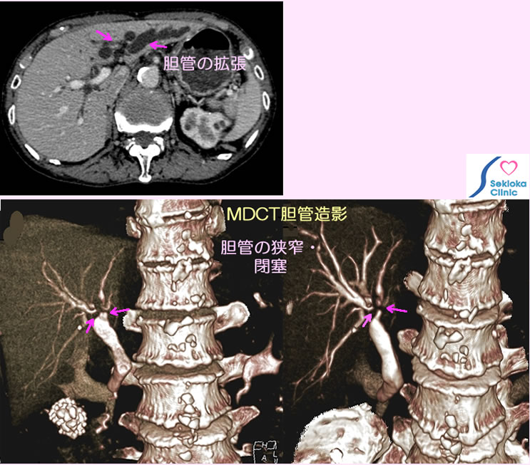 胆管がん画像