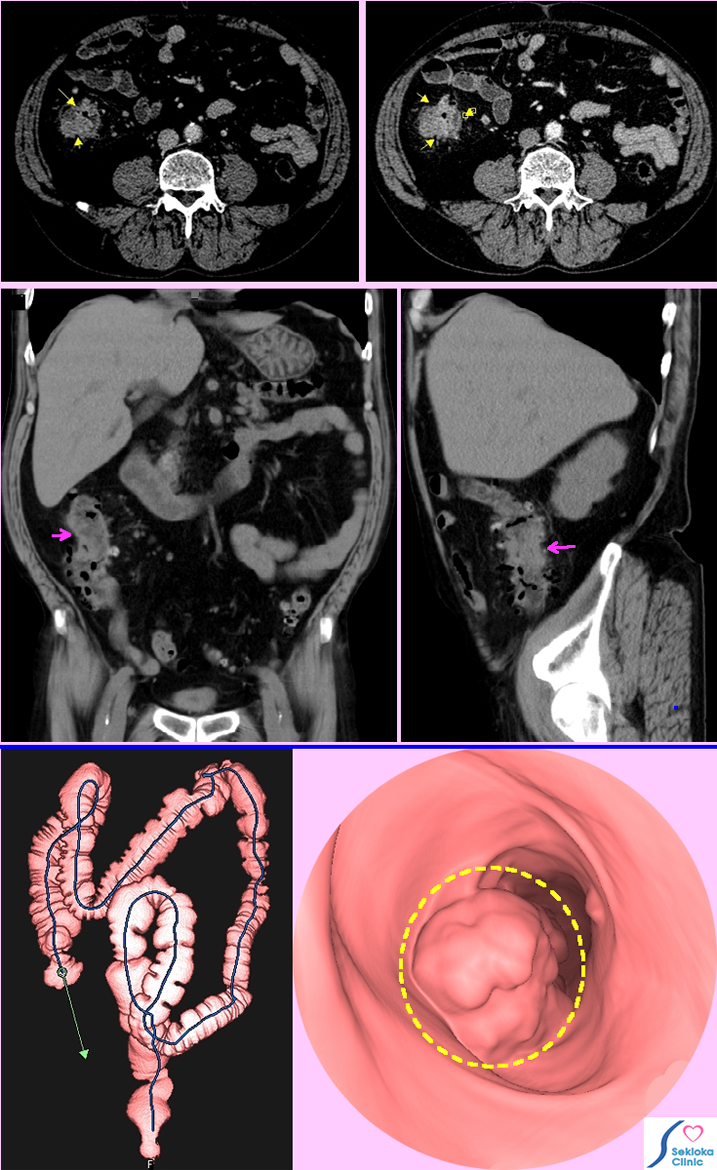 大腸癌のMDCTによる診断