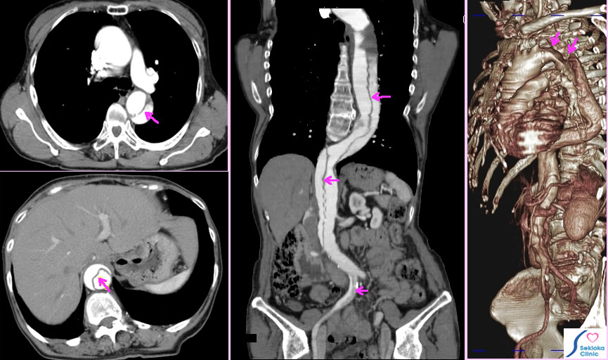 解離性大動脈瘤　画像