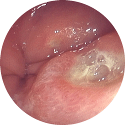 食道潰瘍内視鏡