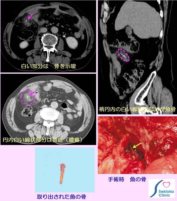 腹膜炎　魚の骨