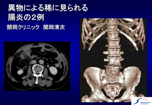 魚骨・バリウム消化管傷害