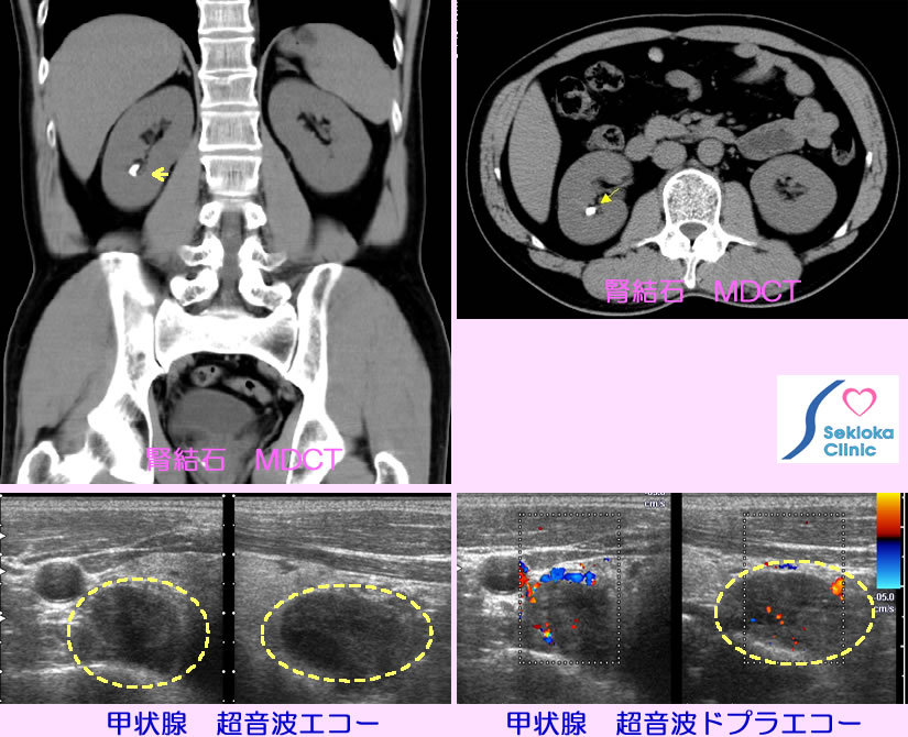 副甲状腺機能亢進症