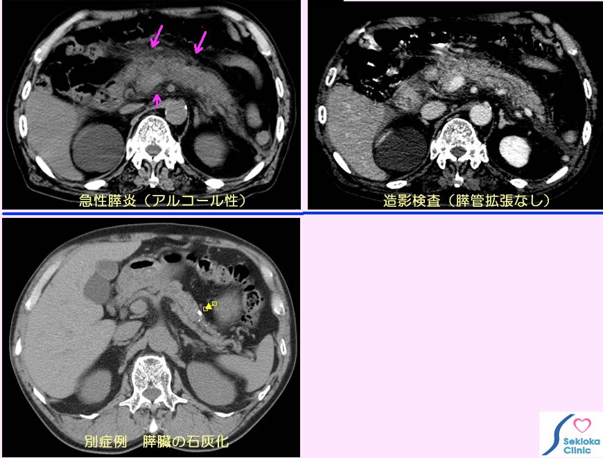 急性膵炎 CT所見