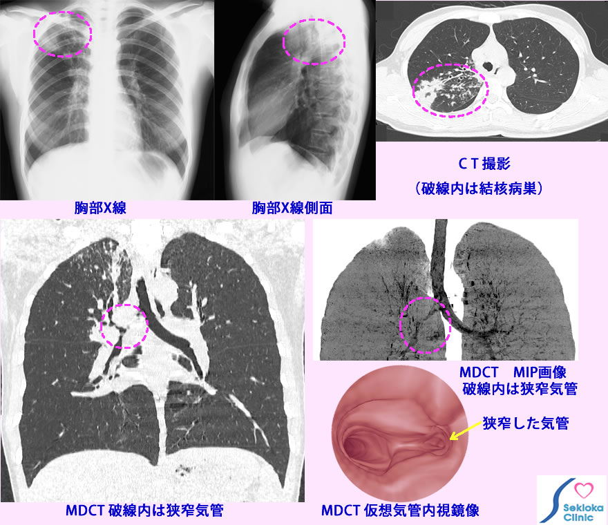 肺結核、気管支結核
