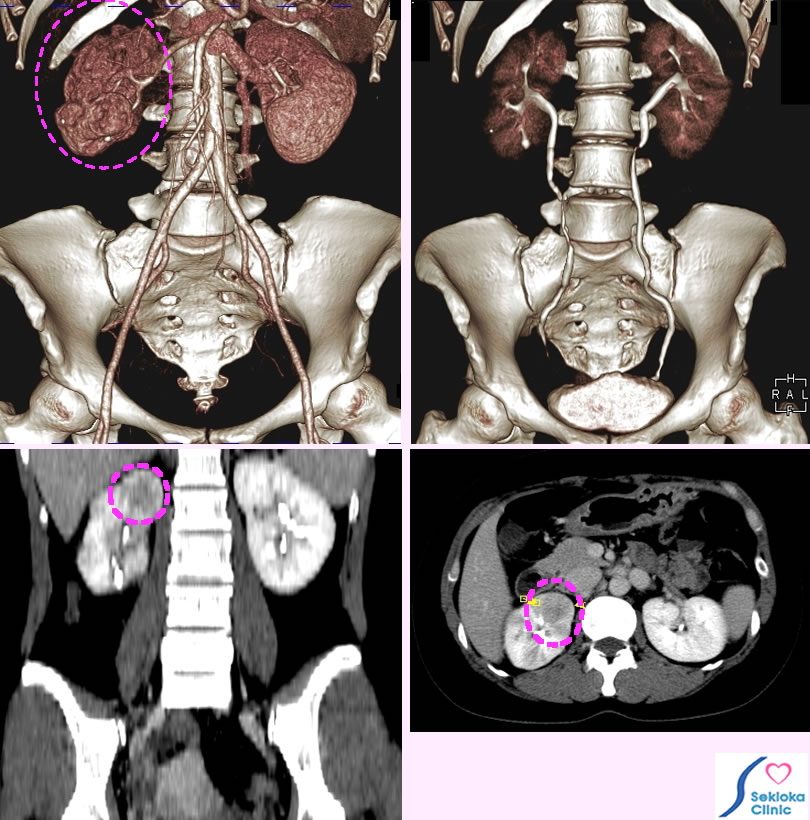 腎盂炎　診断と治療