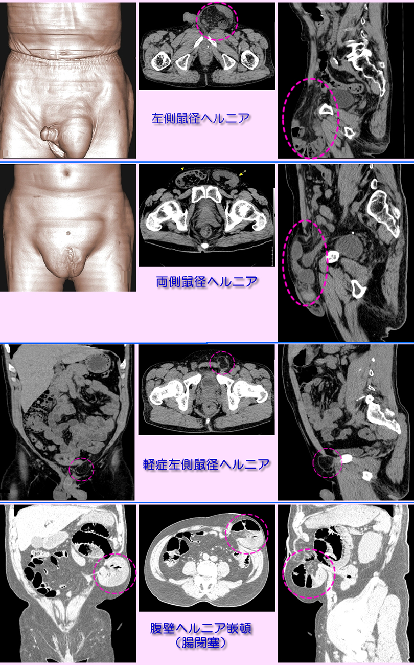 ヘルニア（鼠径・腹壁）