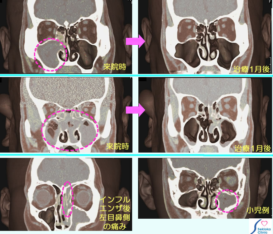 副鼻腔炎　CT診断
