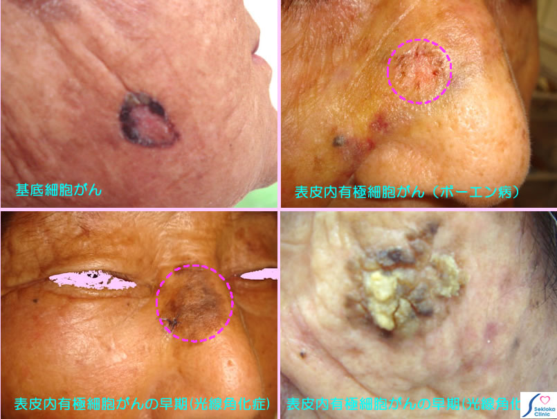 皮膚がんの写真