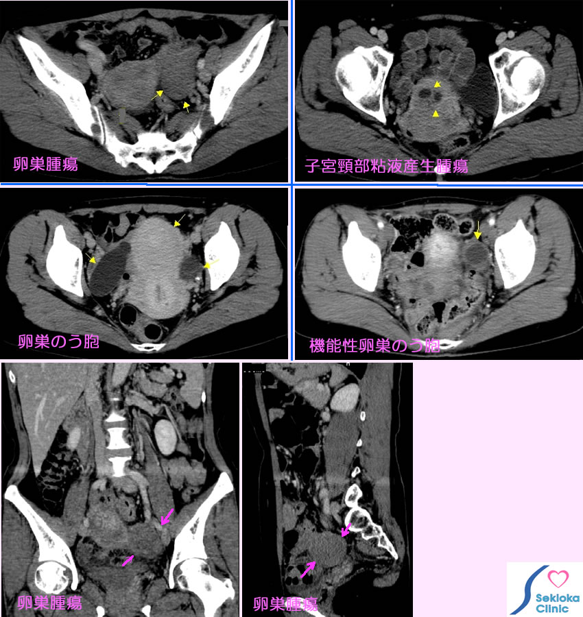 子宮・卵巣腫瘍　診断