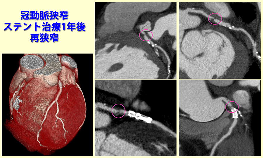 ステント治療後再狭窄例