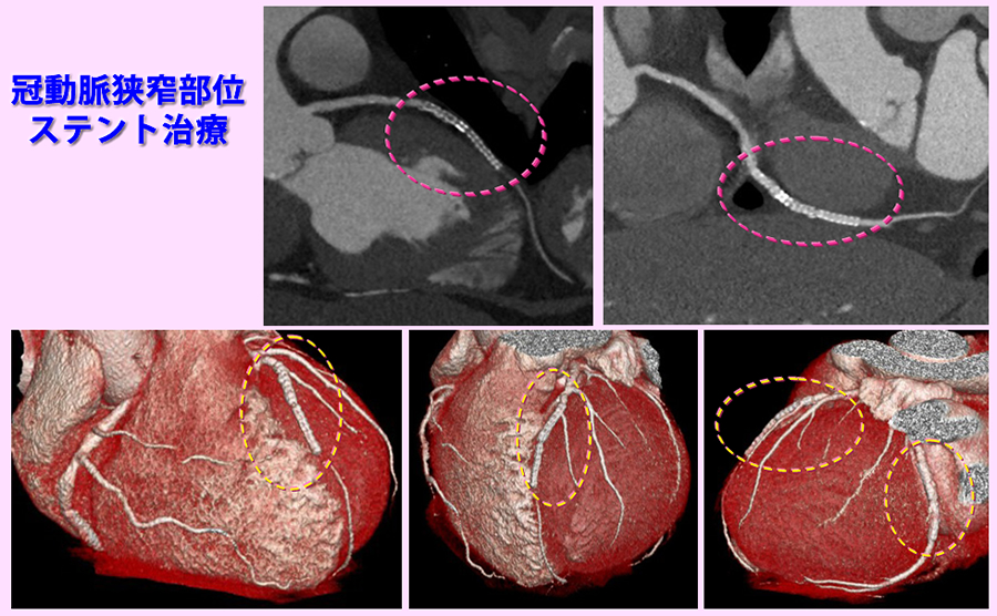 冠動脈形成術ステント