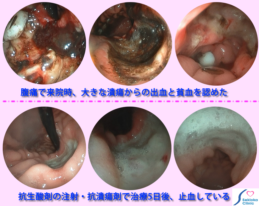 胃悪性リンパ腫内視鏡画像
