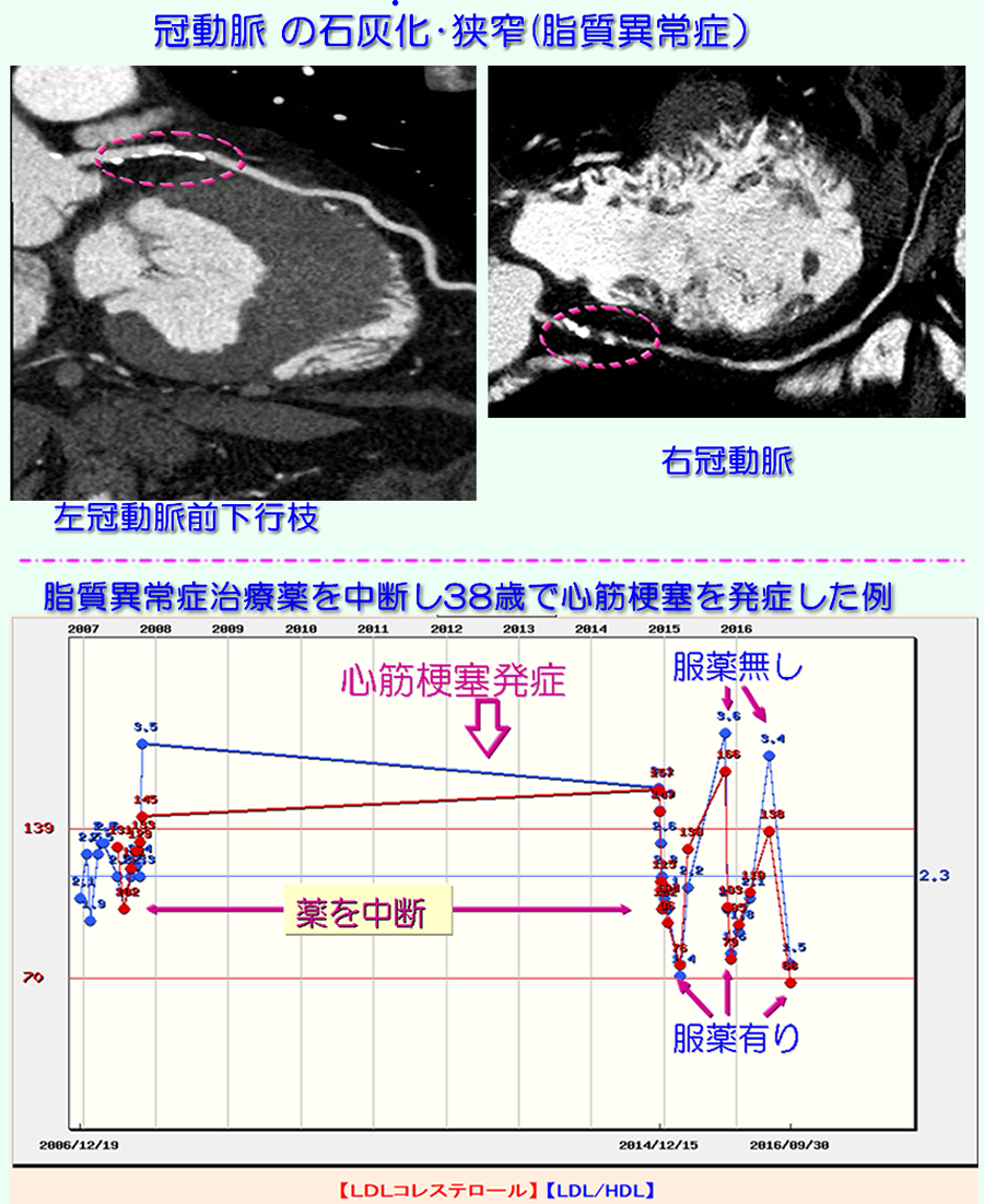 脂質異常症と冠動脈疾患